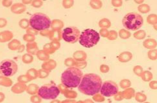 A microscope image of CML blood smear with nine white blood cells.
