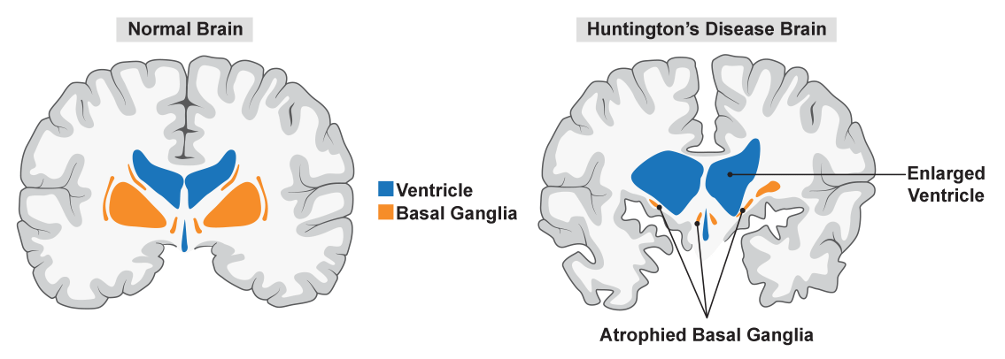 The left side of the two-part diagram is labeled Normal Brain. It shows the two hemispheres of the brain with the creases and folds of the gray matter. Two pairs of equal size wing-shaped structures appear roughly in the middle, one blue and one orange. Several narrow, elongated orange areas surround them, with one narrow droplet shaped blue area appearing between the two orange areas. A legend indicates that the blue is Ventricle and the orange is Basal Ganglia. The right side of the diagram is labeled Huntington’s Disease Brain. It shows the two hemispheres of the brain with irregular creases and folds in the gray matter and a gap between the hemispheres. The blue structures appear much larger than in the normal brain and are irregularly shaped and of unequal sizes. One is labeled Enlarged Ventricle. The orange structures are much smaller than in the normal brain and are labeled Atrophied Basal Ganglia.