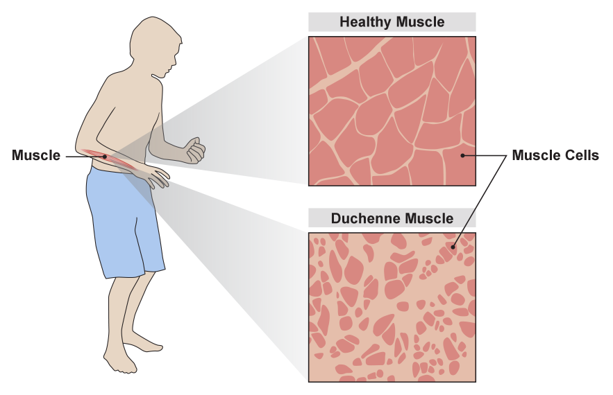 An outline of a boy wearing short pants and standing slightly hunched with his arms bent at the elbows and the fingers of one hand closed. A long red section of one of his forearms is labeled Muscle and is shown in two different expanded views. The one at top is labeled Healthy Muscle and shows pink cells in various shapes and sizes with little space in between them. The view below is labeled Duchenne Muscle and shows shrunken pink cells with large gaps in between them. The cells in both expanded views are labeled Muscle Cells.