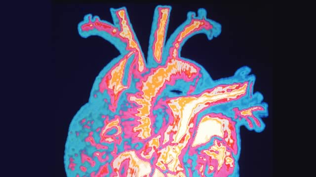 A heart CT scan