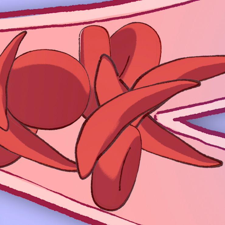 Normal and sickled red blood cells passing through a blood vessel.