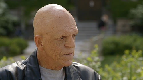 Photo of Michael Berryman who has ectodermal dysplasias