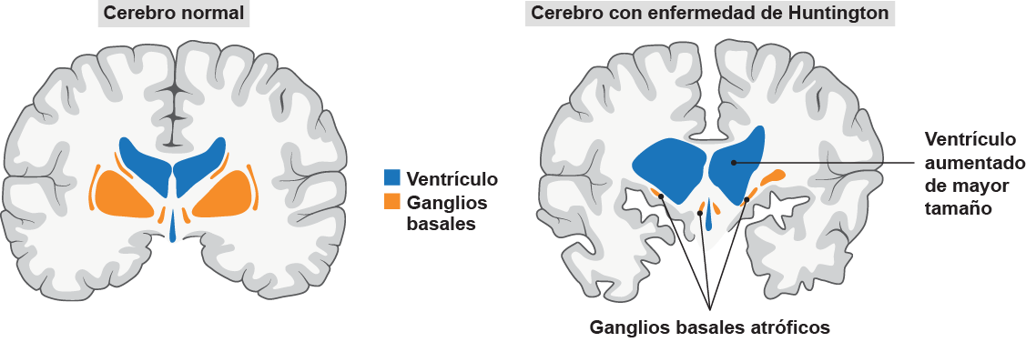 El lado izquierdo del diagrama de dos partes está rotulado como Cerebro normal. Muestra los dos hemisferios del cerebro con los pliegues de la materia gris. Dos pares de estructuras en forma de ala y de igual tamaño aparecen cerca del centro, una azul y otra naranja. Varias áreas estrechas y alargadas de color naranja las rodean, y entre las dos zonas anaranjadas aparece un área azul estrecha en forma de gota. Una leyenda indica que lo azul es un Ventrículo y lo naranja son los Ganglios basales. El lado derecho del diagrama está rotulado como Cerebro con enfermedad de Huntington. Muestra los dos hemisferios del cerebro con pliegues irregulares en la materia gris y un espacio entre los hemisferios. Las estructuras azules parecen mucho más grandes que en el cerebro normal y tienen formas irregulares y tamaños desiguales. Una de ellas está rotulada como Ventrículo aumentado de tamaño. Las estructuras naranjas son mucho más pequeñas que en el cerebro normal y están rotuladas como Ganglios basales atróficos.