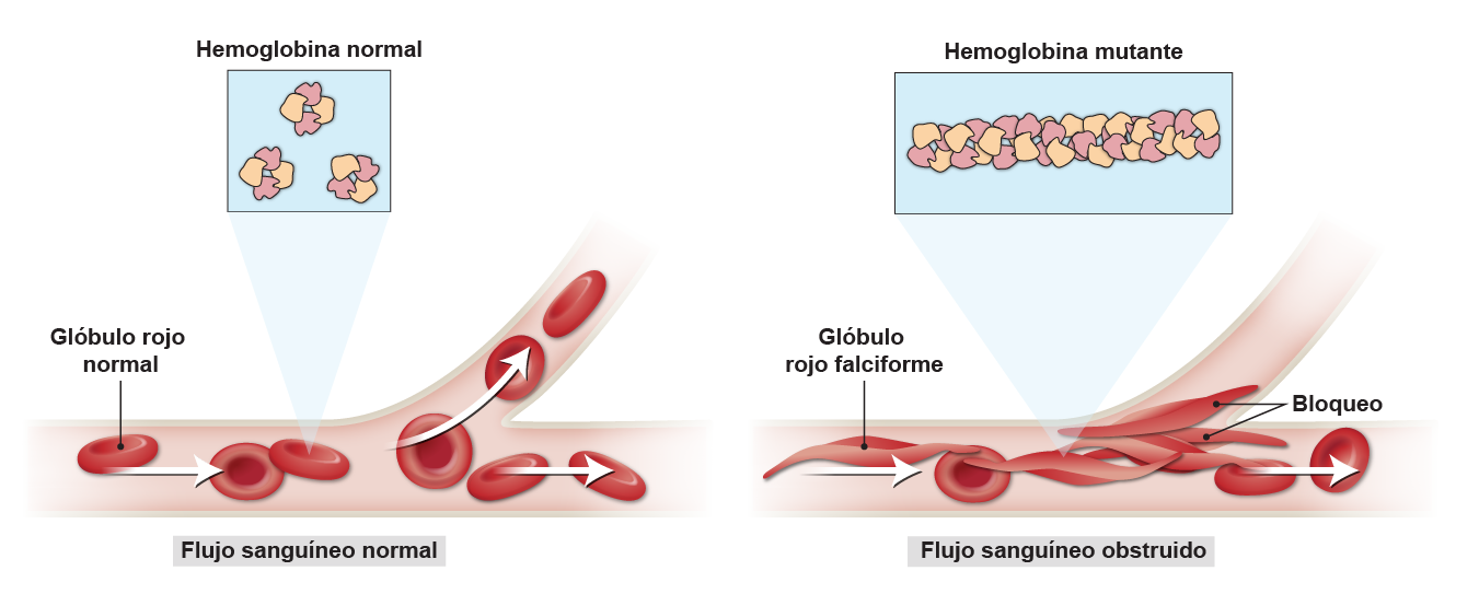 El lado izquierdo del diagrama está rotulado como Flujo sanguíneo normal. Representa un vaso sanguíneo ramificado por donde pasan discos rojos rotulados como Glóbulo rojo normal. Las flechas indican la dirección del flujo sanguíneo. Una vista ampliada de una de las células sanguíneas muestra tres cúmulos globulares separados, cada uno consta de dos áreas naranjas y dos rosas. Esta vista ampliada está rotulada como Hemoglobina normal. El lado derecho del diagrama está rotulado como Flujo sanguíneo obstruido. Representa el mismo vaso sanguíneo ramificado, pero algunos de los discos rojos están alargados en forma de hoz y están etiquetados como Glóbulo rojo falciforme. Las flechas indican la dirección del flujo sanguíneo y un grupo de células falciformes en el sitio de ramificación del vaso sanguíneo está rotulado como Bloqueo. Una vista ampliada de una de las células falciformes muestra una serie de cúmulos globulares similares a los del diagrama de la izquierda formando una cadena y están rotulados como Hemoglobina mutante.
