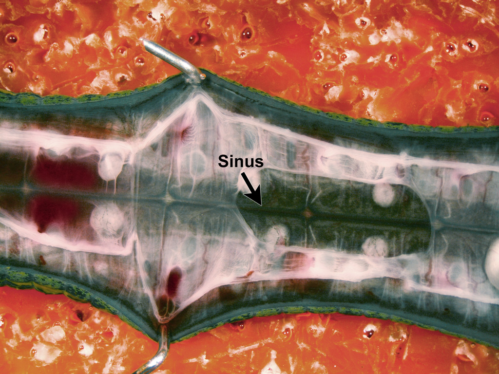 A second close-up of the cut-open leech in the dissection dish. Some of the leech's internal organs have been removed, revealing structures on the ventral side of the body cavity. These structures include a dark green line running along the middle of the leech, which is labeled 'sinus.'